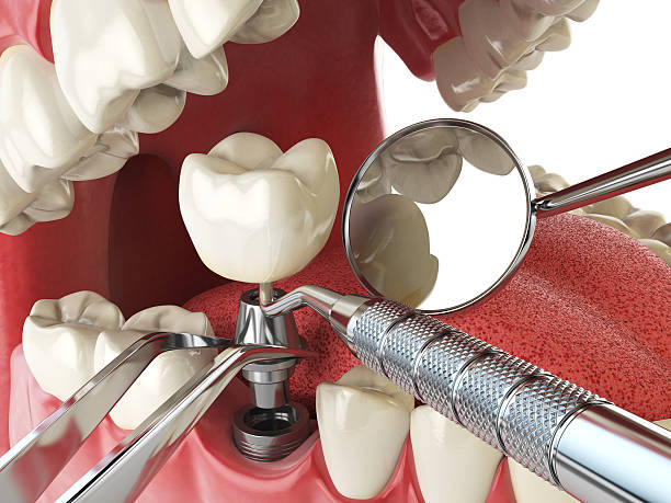Best Emergency Root Canal Treatment in Brazil, IN